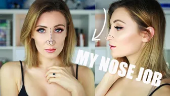 MY NOSE JOB: Plastic Surgery #2 Storytime I Holly Wolf