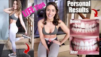 Teeth straightening SMILE DIRECT, Good DEALS & Mondays Recipe