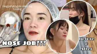 GOT MY NOSE JOB IN TAIWAN .. FINALLY !!! | ERIKA RAMOS