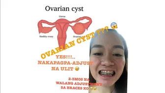 OVARIAN CYST?? + NAGPAADJUST AKO NG BRACES KO