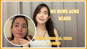 NAGPA-FRACTIONAL CO2 LASER TREATMENT AKO (no to acne scars) | ERIKA RAMOS