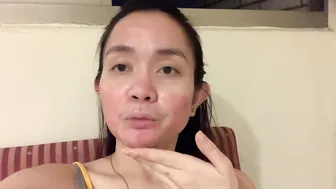 NAGPA-FRACTIONAL CO2 LASER TREATMENT AKO (no to acne scars) | ERIKA RAMOS #5